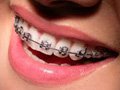 remboursement mutuelle orthodontie